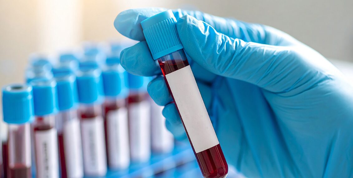 Typhoid Test: Purpose, Types, Procedure, Preparation, Results & Benefits