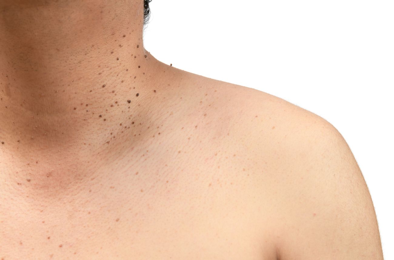 What Are Benefits Of Seborrheic Keratosis Treatment?