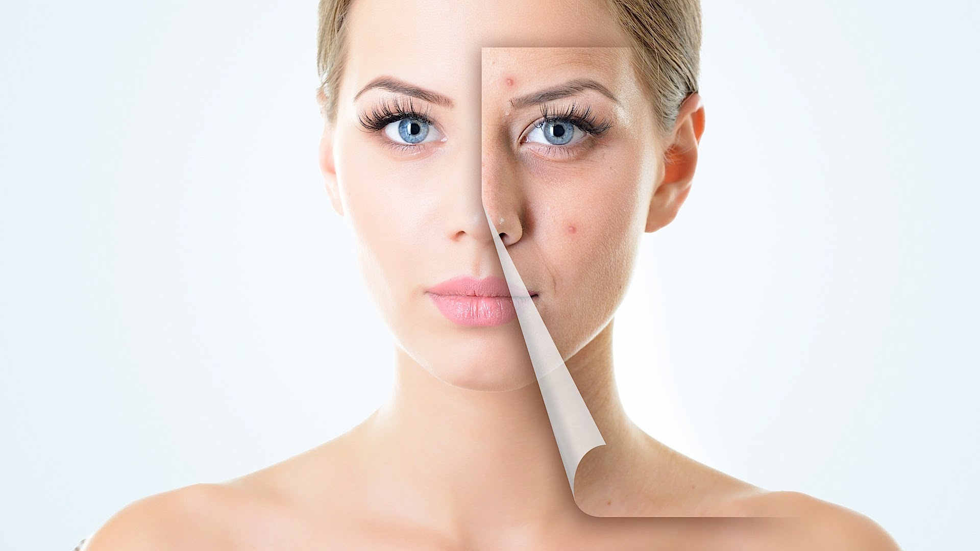 What Are the Benefits of Acne Treatment in Abu Dhabi