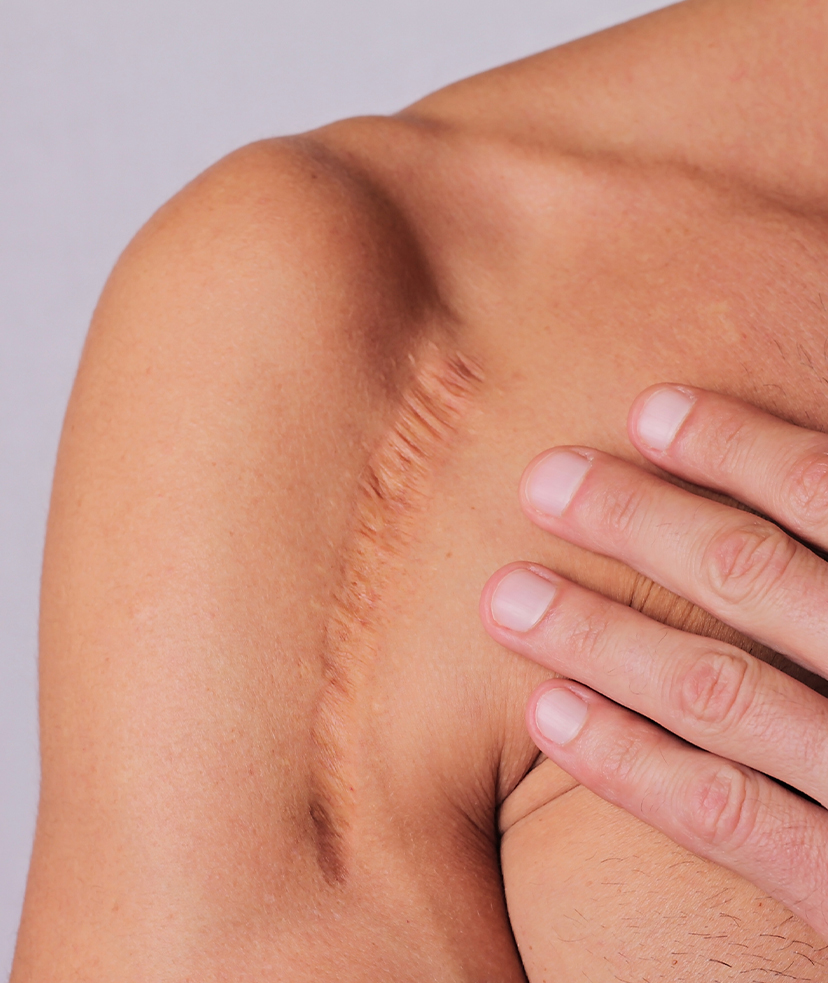 What-Are-the-Benefits-of-Laser-Scar-Removal
