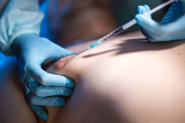 What-Are-the-Main-Benefits-of-Gynecomastia-Surgery