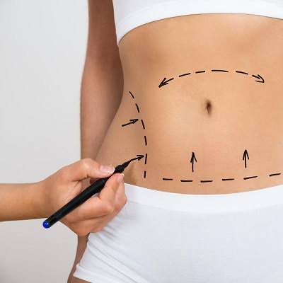 What Results Can Mini Abdominoplasty Deliver?