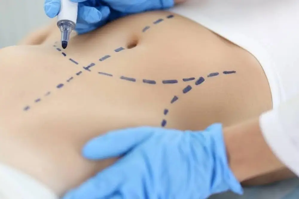 What Results Can You Expect From Tummy Tuck Abu Dhabi