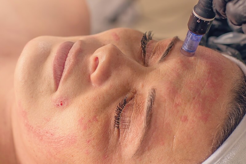 What Should You Expect After Laser Acne Scar Treatment?