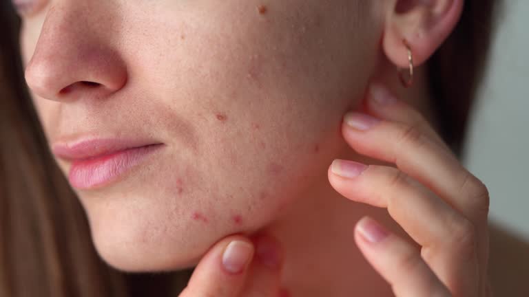 What Skin Issues Can Acne Treatmen Effectively Treat for Clearer Skin?