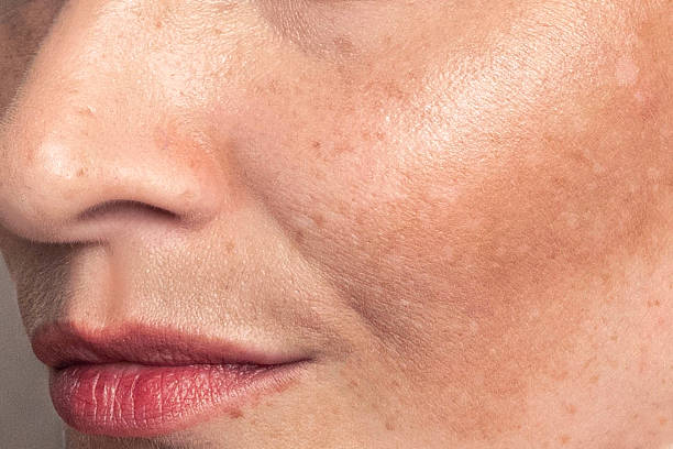 What Skin Types Benefit from Pigmentation Treatment?