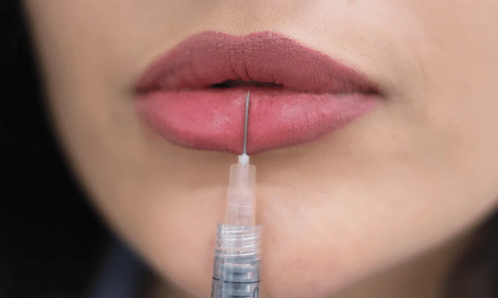Discover the Beauty of Refined Lip Contours with Russian Lip Fillers
