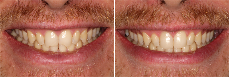 Affordable Cosmetic Dentistry vs Premium Treatments: What’s the Difference?