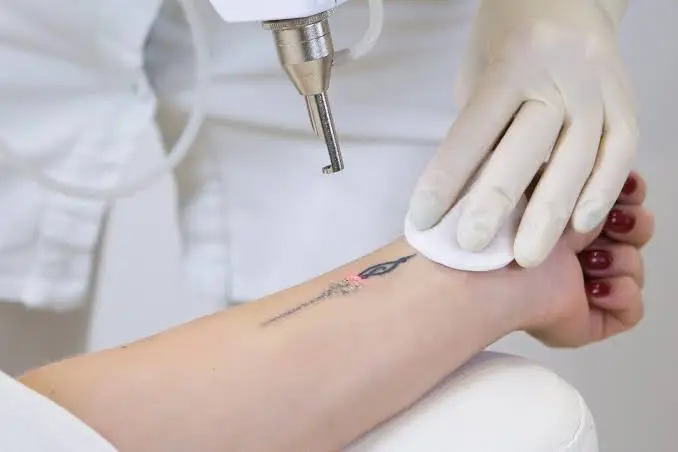 Laser Tattoo Removal The Ultimate Guide to Safe and Effective Ink Removal