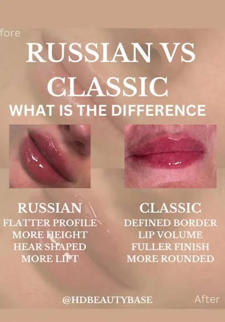Is Russian Lip Fillers in Abu Dhabi Better Than Classic Fillers?